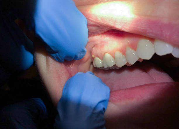 Best Emergency Dentist for Lost Fillings or Crowns in USA